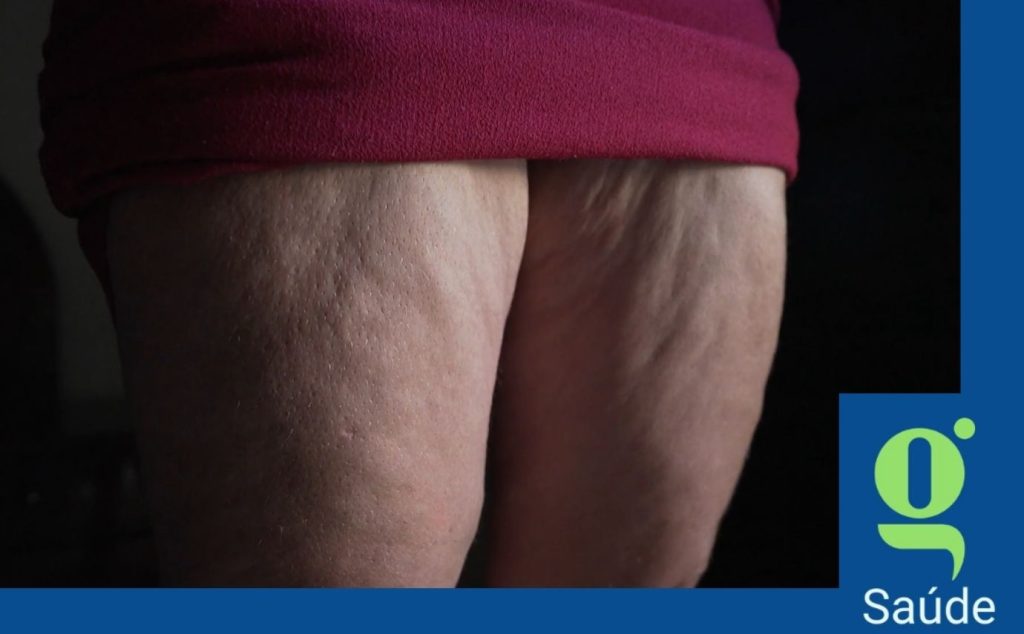 O que é lipedema? Entenda a doença sem cura que afeta 9 milhões de mulheres no Brasil